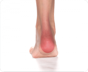 Image of Foot with Achilles Tendonitis