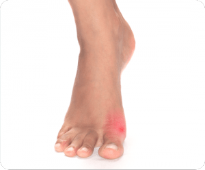 Image of Foot with Bunions