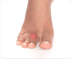 Image of Foot with Foot Calluses