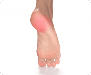 Image of Foot with Foot Injury