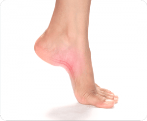 Image of Foot with Plantar Fascitis