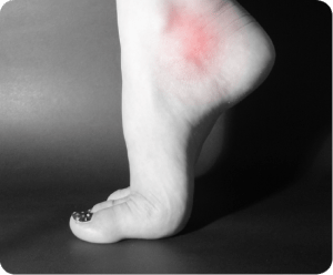 Image of Foot with Post-Tib Tendonitis